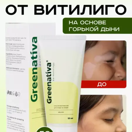 Гель от витилиго белых пятен кожи. GREENATIVA